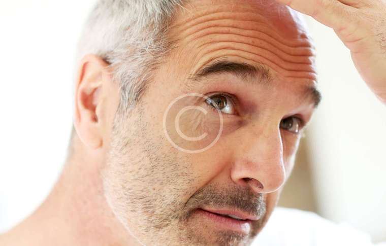 FUE Hair Transplant